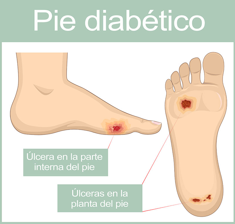 Pié Diabético en Narón Clínica Podológica Tabas en Narón.